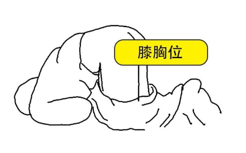 一根手指摸出90%直肠癌,肛肠科医生最不希望你放弃的检查_腾讯新闻