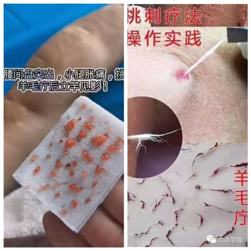 什么是羊毛疔羊毛疔对人体有那些危害怎么治疗