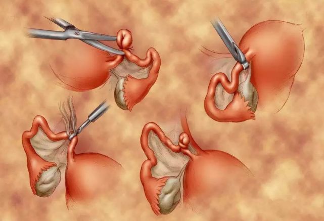 结扎8年,想生孩子怎么办?