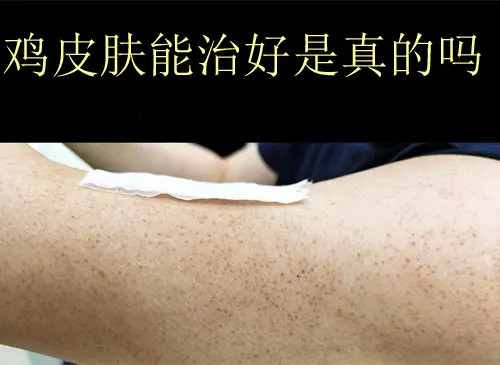 鸡皮肤后天的怎么治疗(后天形成的鸡皮肤可以完全治愈吗)