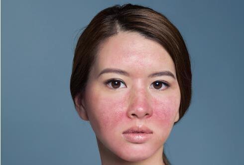 天气转凉红血丝该怎么护理 正确方法教你告别"大红脸"