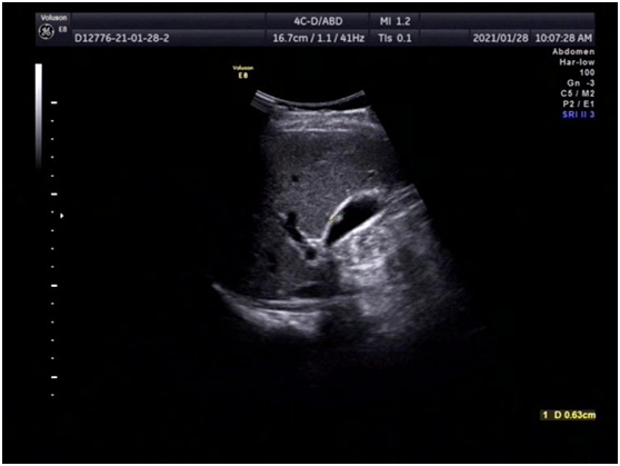 体检发现胆囊息肉或结石怎么办 腾讯新闻