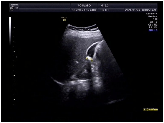 体检发现胆囊息肉或结石怎么办 腾讯新闻