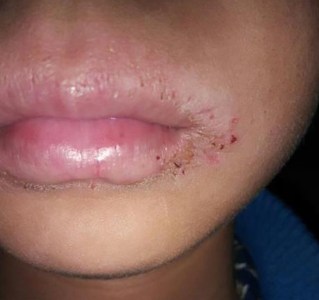 唇炎一个接吻都不可以的皮肤病