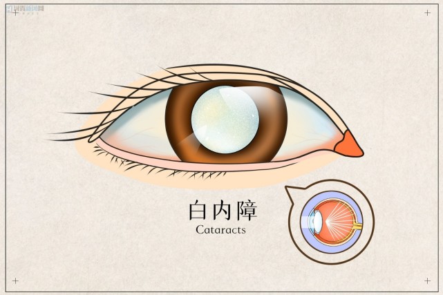 會出現晶狀體膨脹性青光眼,晶狀體溶解性青光眼,虹膜睫狀體炎等併發症