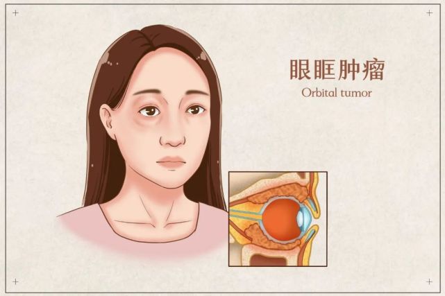 石家莊一男子被查出腫瘤體檢時眼睛曾發現異常