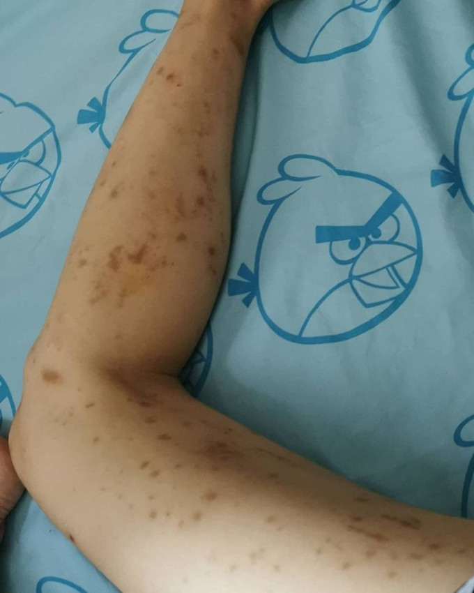 32岁张惠雅疑似为情所困体重暴跌至80斤下巴长疮腿上满是黑点