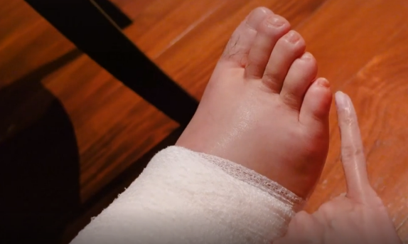 陈赫受伤后右脚浮肿为了洗个澡张子萱蹲地为其换药绑上保鲜膜