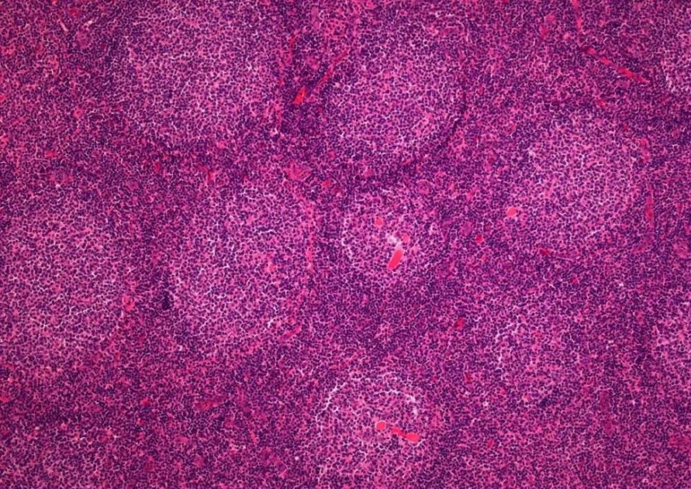 近年来滤泡性淋巴瘤在中国的发病率不断升高[3],而这类肿瘤通常很难被