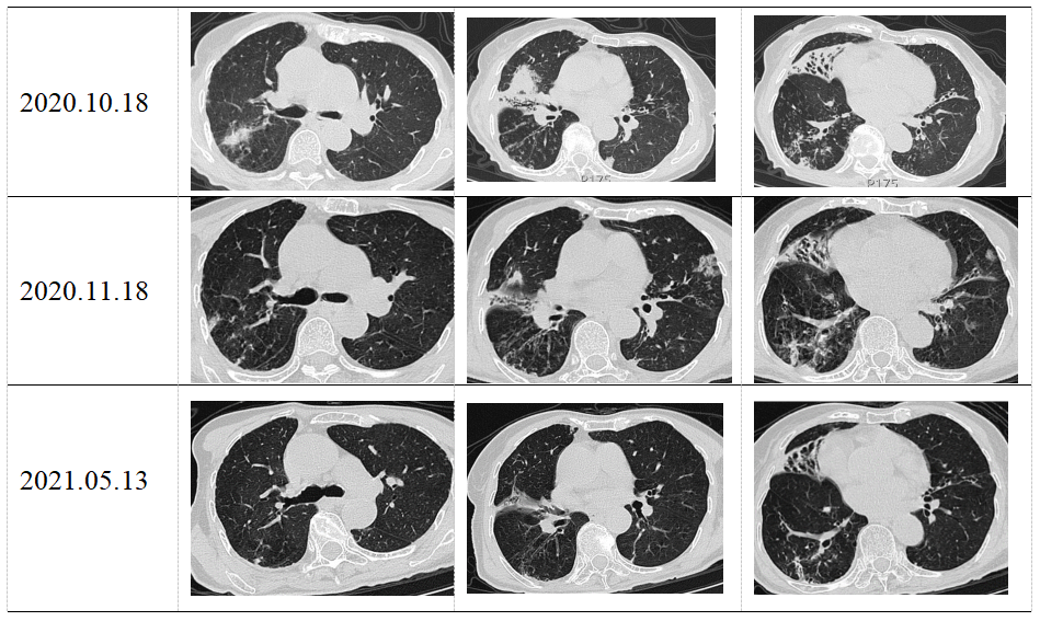 拯救温夫人奴卡菌肺炎一例诊治分享