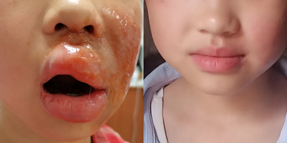 9岁女孩被蒸汽烫伤_腾讯新闻