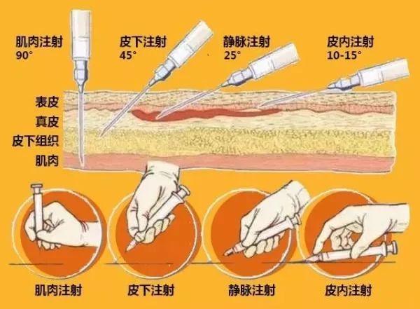 说到这里,我们需要先说一下,打针的主要集中注射方式,简单可分为静脉