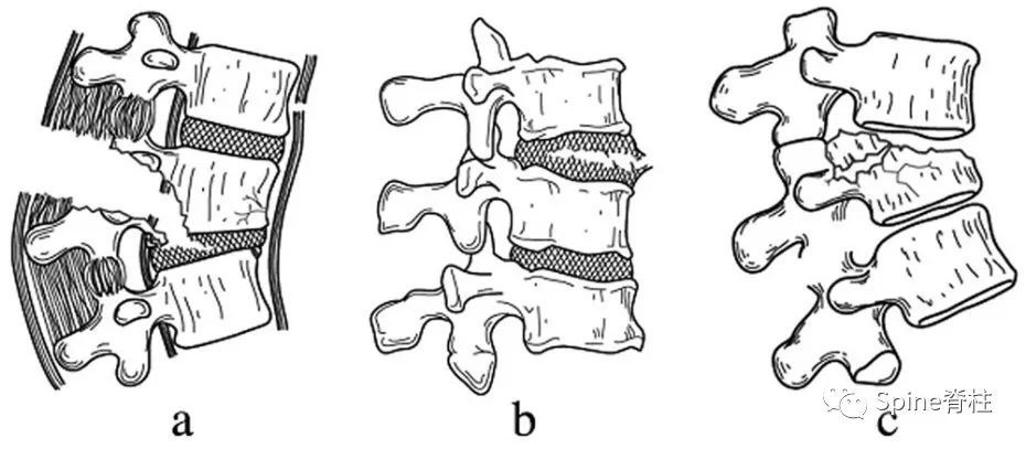 骨科精读一文读懂胸腰椎骨折的ao分型与tlics载荷分享评分