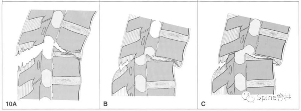 1.3)图:屈曲半脱位 a型骨折(b1.2.1).