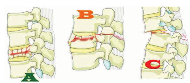 損傷特徵a型損傷可單獨發生在1個椎體或與b型,c型同時發生a型和b1型