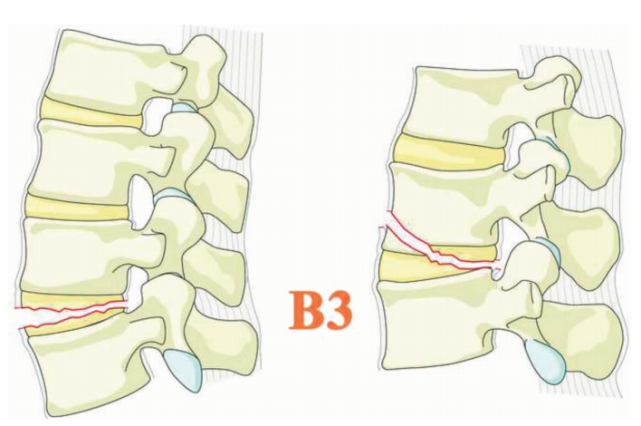 骨科精讀|一文讀懂胸腰椎骨折的ao分型與tlics,載荷分享評分!