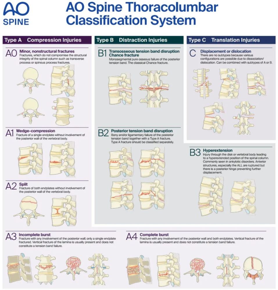 骨科精讀|一文讀懂胸腰椎骨折的ao分型與tlics,載荷分享評分!