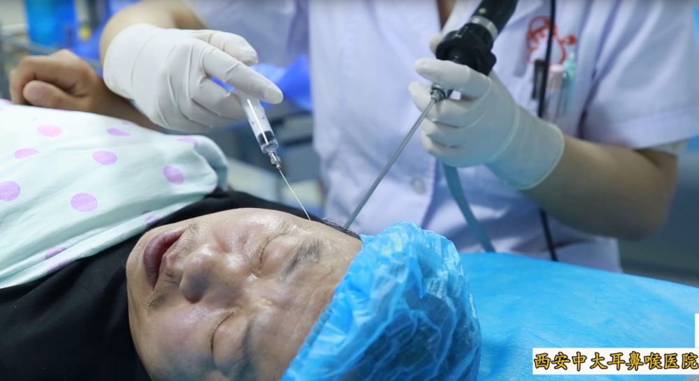 突发性耳聋需及时抢救错过最佳治疗期鼓室给药来挽救