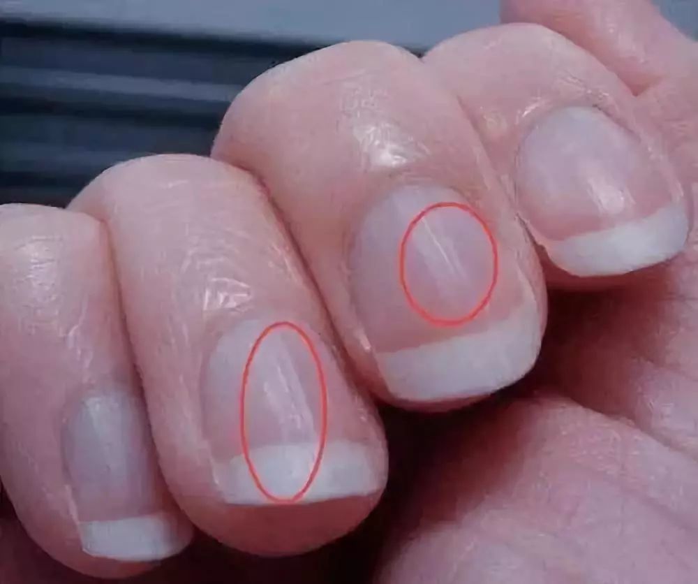 如何通过指甲检视健康