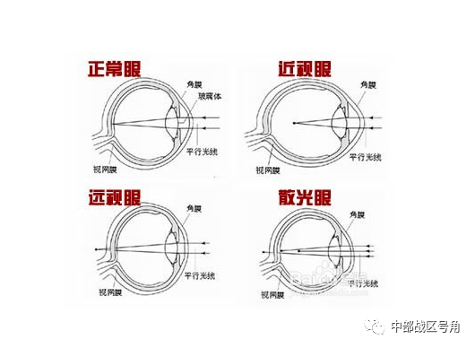 凹聚焦,因此无法产生清晰的成像,这称为屈光不正,包括近视,远视和散光