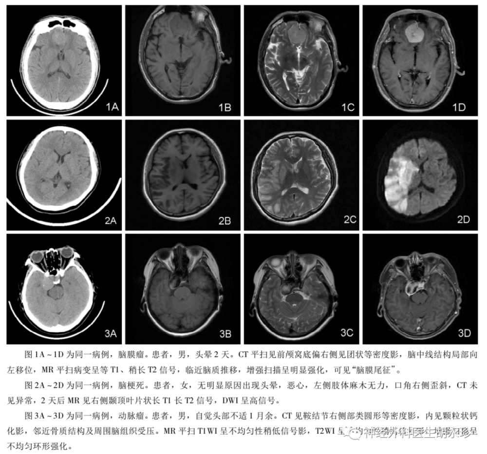 颅脑ct检查容易被忽略的病变 腾讯新闻