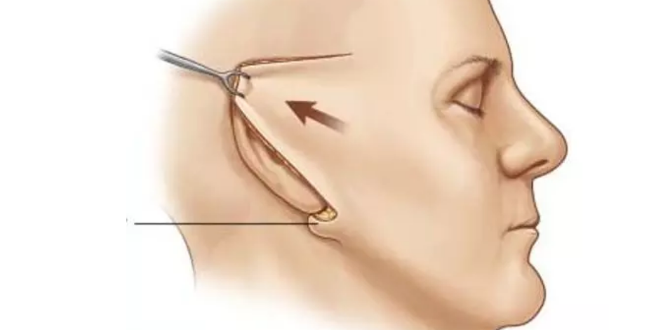 扒一扒:拉皮手术多大年龄做合适?了解清楚在决定!