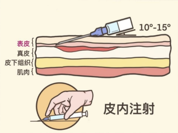 皮内注射俗称"皮试",就是大家如果感冒严重会打消炎药,比如青霉素