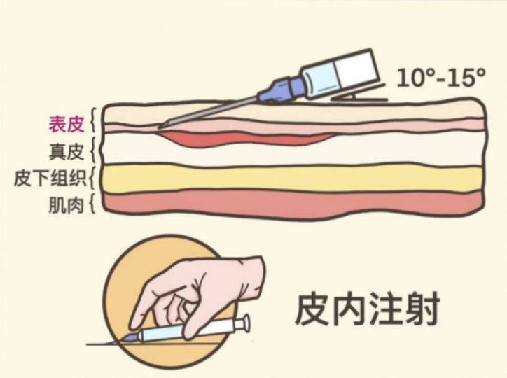 比如青黴素,頭孢呋辛等這些藥屬於易過敏藥物,需要做皮試