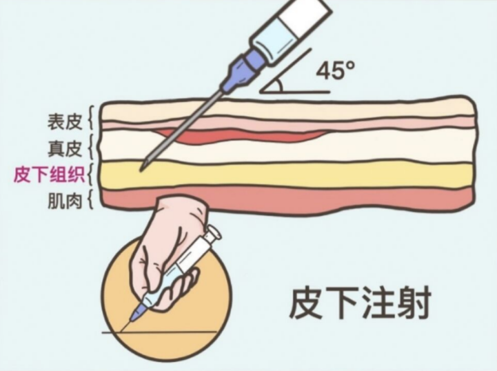 最不疼:肌肉注射疼痛感:★★肌肉注射就是"屁股针",感冒发烧要迅速