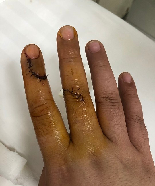 宝鸡一酒店洗漱盆破裂,割伤房客右手