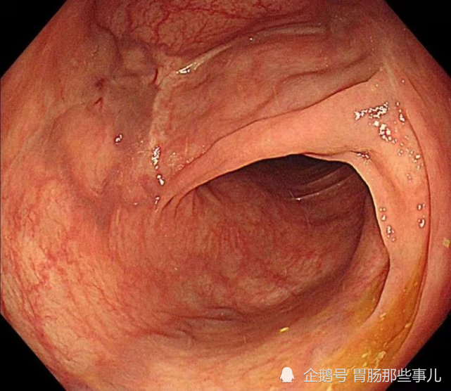 神秘消失的結腸癌