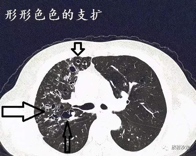经典图谱,详细解说支气管扩张ct小诀窍