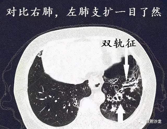 经典图谱,详细解说支气管扩张ct小诀窍_腾讯新闻