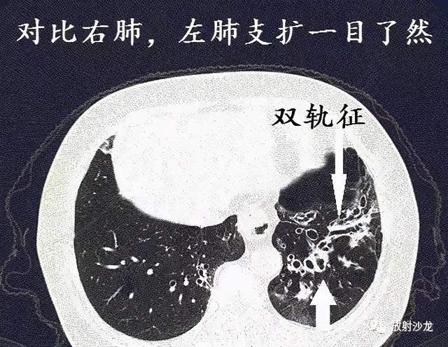 支气管囊肿ct图片图片