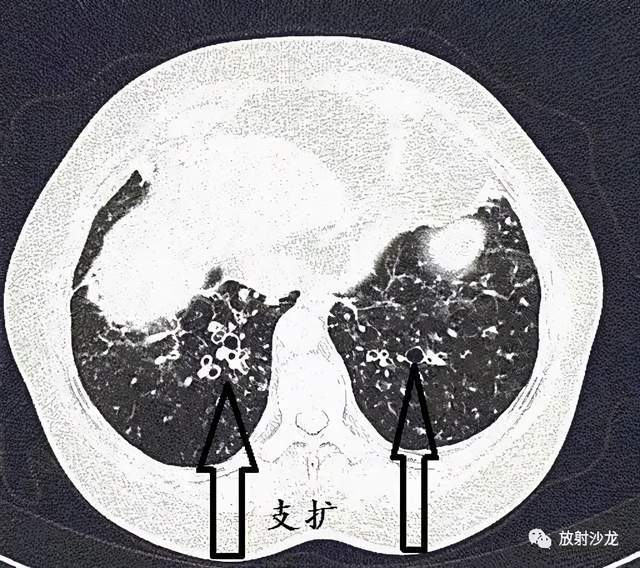 经典图谱,详细解说支气管扩张ct小诀窍