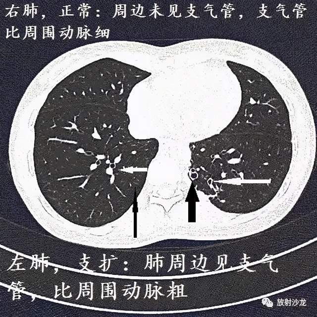 经典图谱,详细解说支气管扩张ct小诀窍