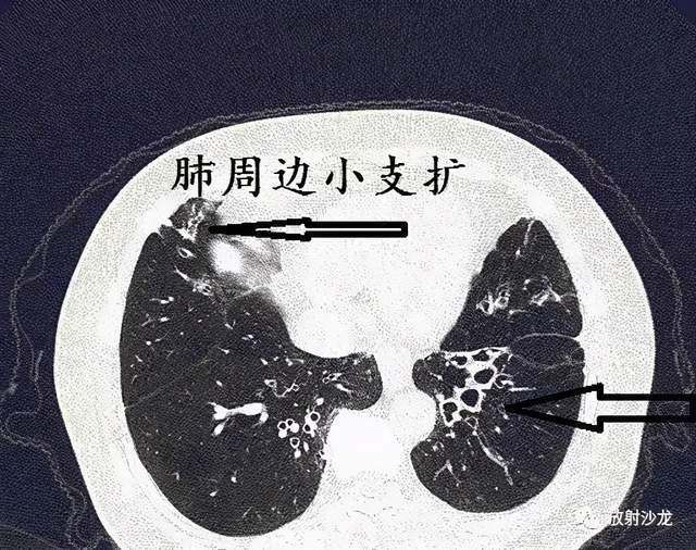 支气管扩张的表现图片