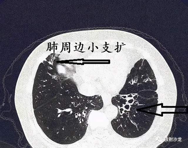 经典图谱,详细解说支气管扩张ct小诀窍_腾讯新闻