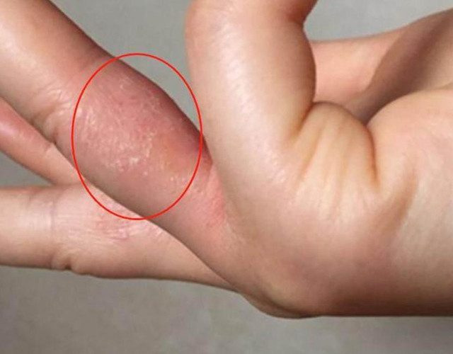 汗疱疹是一种发生于手掌,手指侧面,指端皮肤的复发性水疱病,属于湿疹