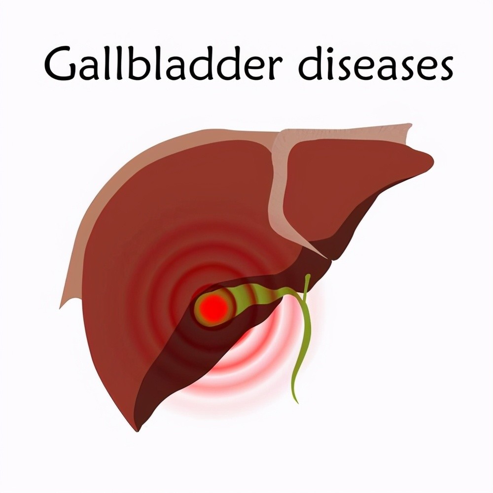 胆囊切除 对身体发难 后遗症不好受 除非这两种情况 别切 腾讯新闻