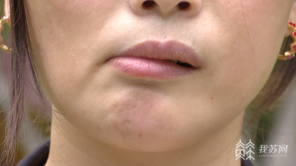 女子下巴吸脂十天后面瘫南京市卫建委正在调查处理