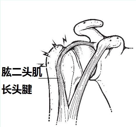 肱二頭肌肌腱病變分型發病病因臨床檢查與治療