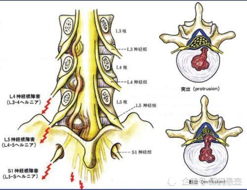 邱氏悬壶:腰椎间盘突出坐骨神经痛是怎么回事?_腾讯新闻