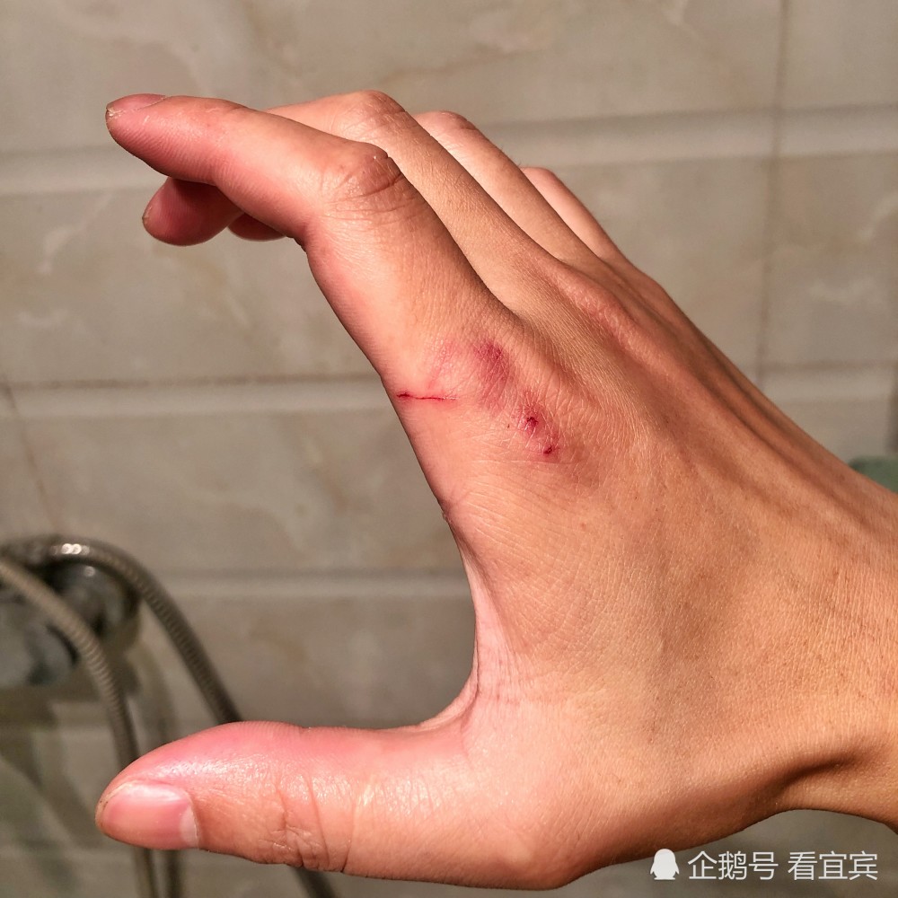 活久见宜宾男子公园看荷花竟然被鱼咬了