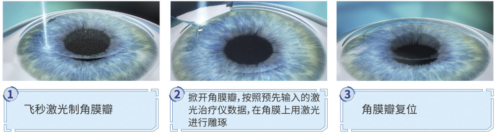 半飛秒激光手術(femto-lasik)缺點:對角膜厚度的要求比較嚴格,目前