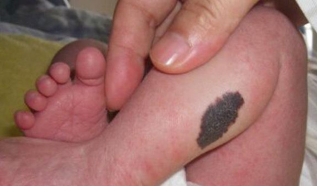 家长:宝宝有很大一块青色胎记怎么办?