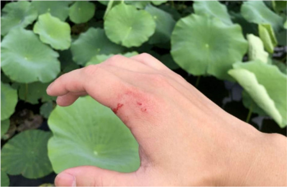 浙江男子野外钓鱼时被不明大鱼咬伤虎口网友太大意了