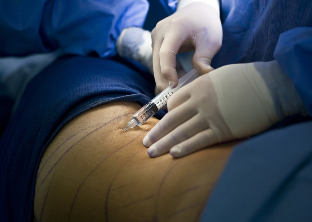 抽脂肪对身体有害吗