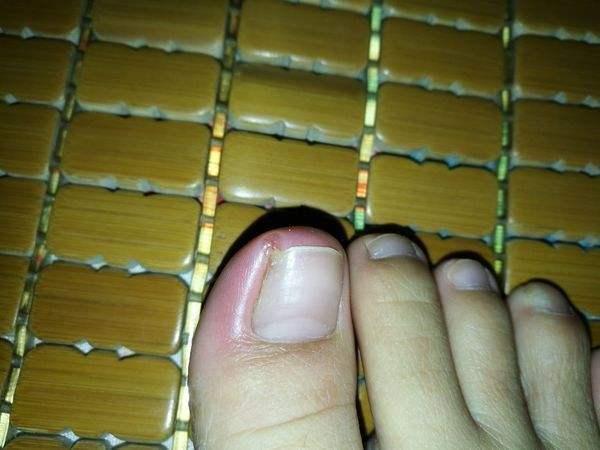 有一种痛叫做甲沟炎