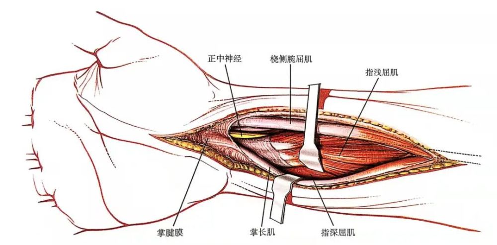 切开掌长肌和桡侧腕屈肌间的前臂筋膜,显露指浅屈肌及其肌腱正中